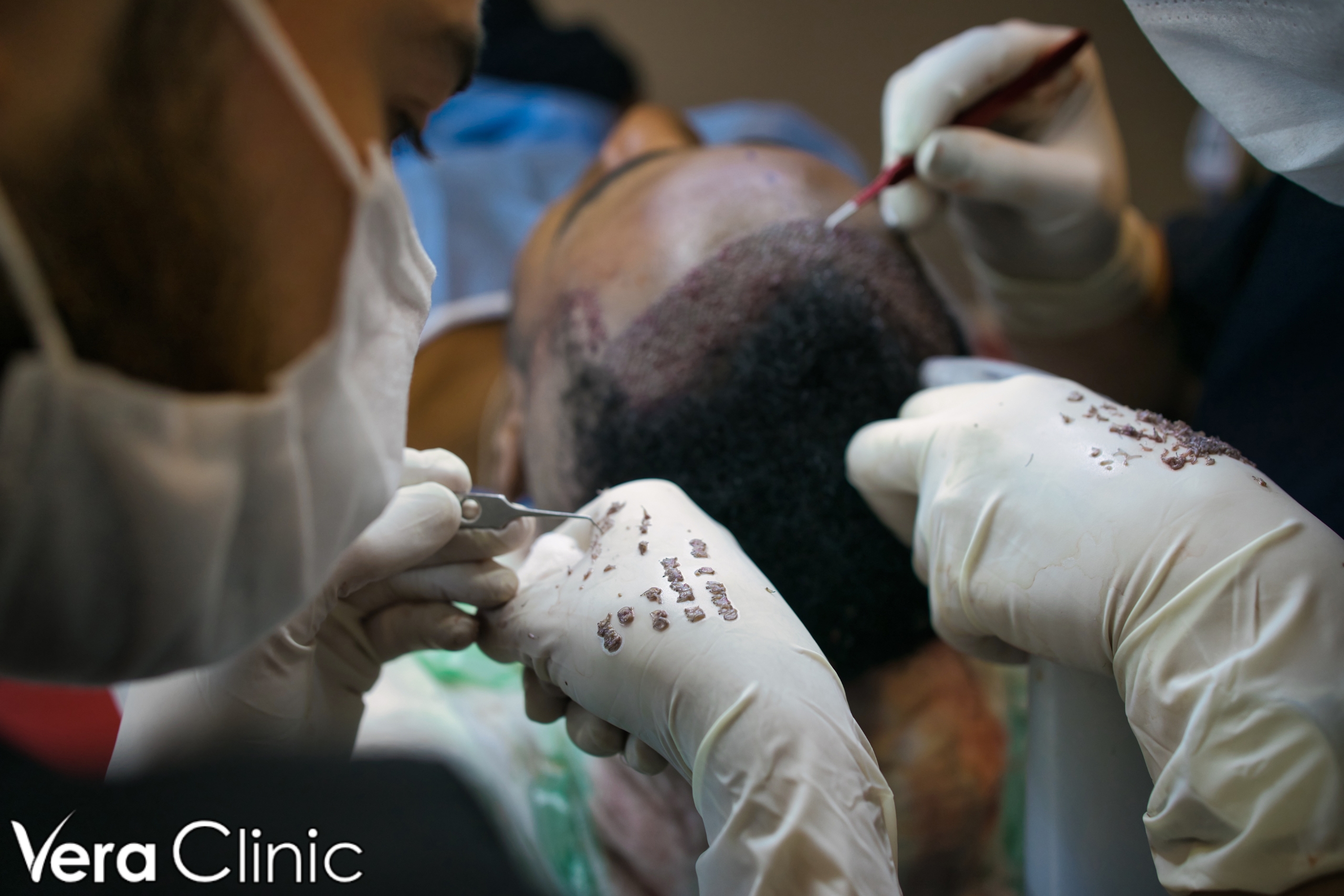hair transplant istanbul