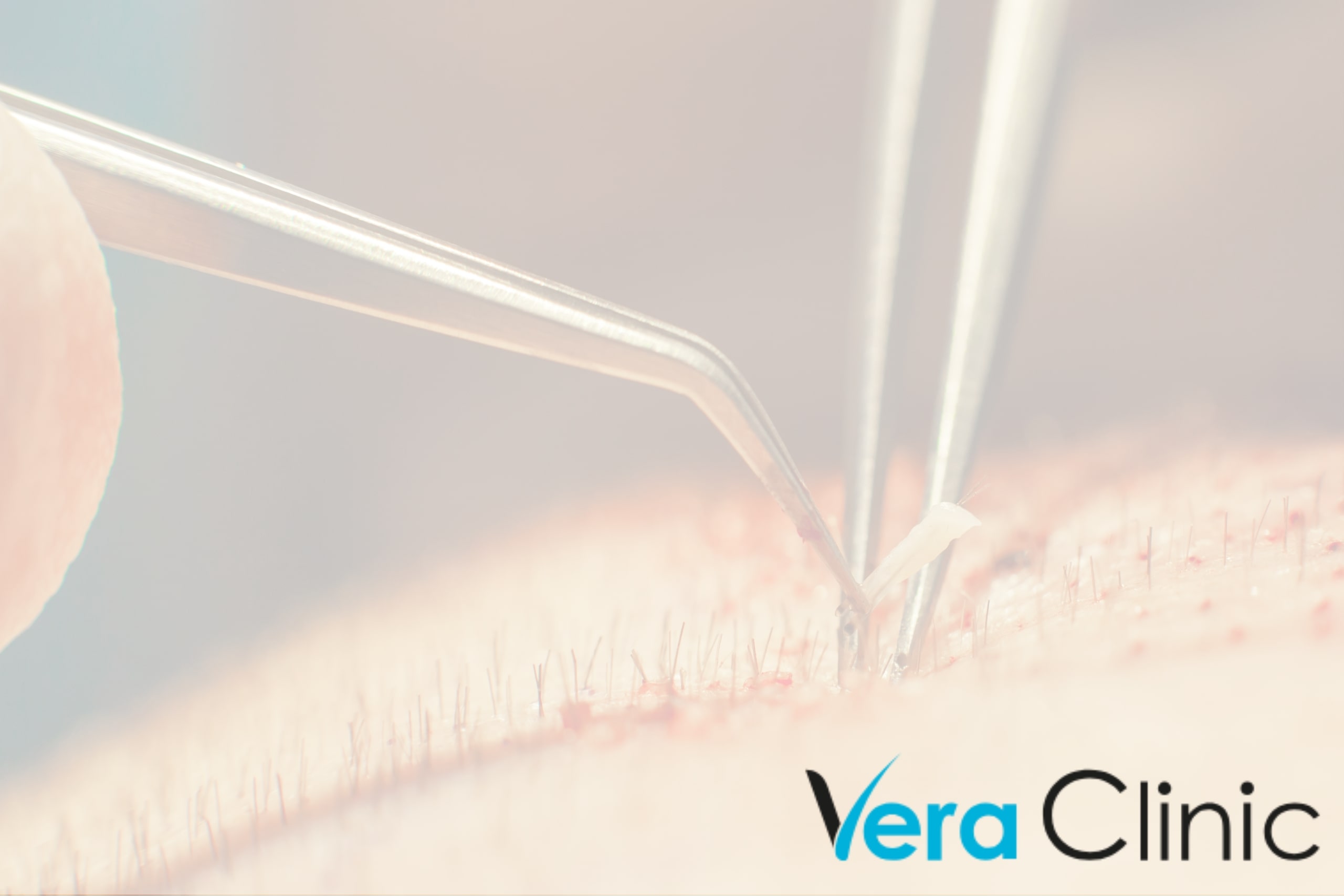 Hair Transplant In Istanbul: The City’s Top Clinics And Surgeons